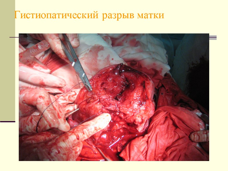 Гистиопатический разрыв матки